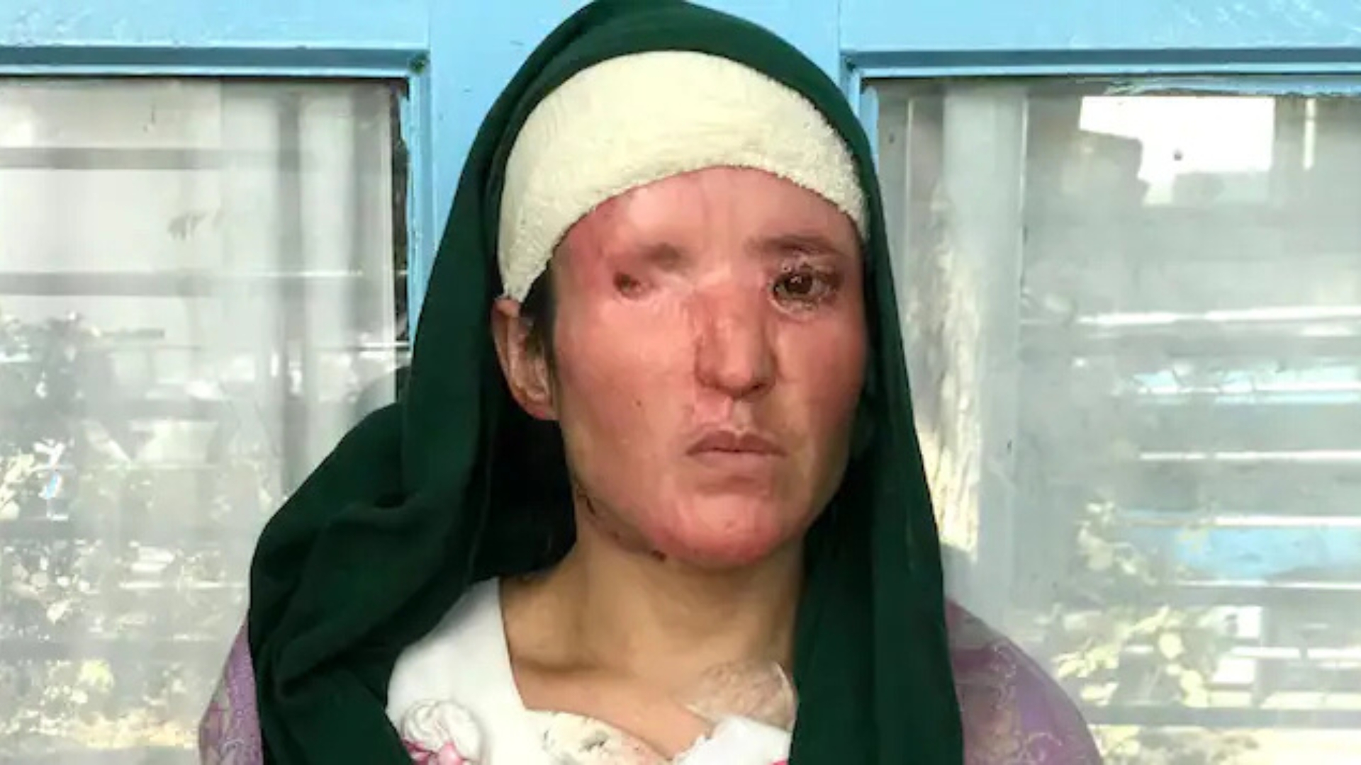 Vangai following the acid attack in Afghanistan.